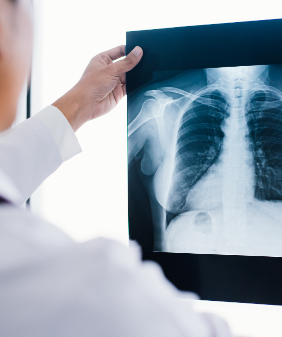 L’ARS Paca publie les résultats du 1er appel à projet visant à soutenir la mise en place de filières « remarquables » de prise en charge du cancer du poumon